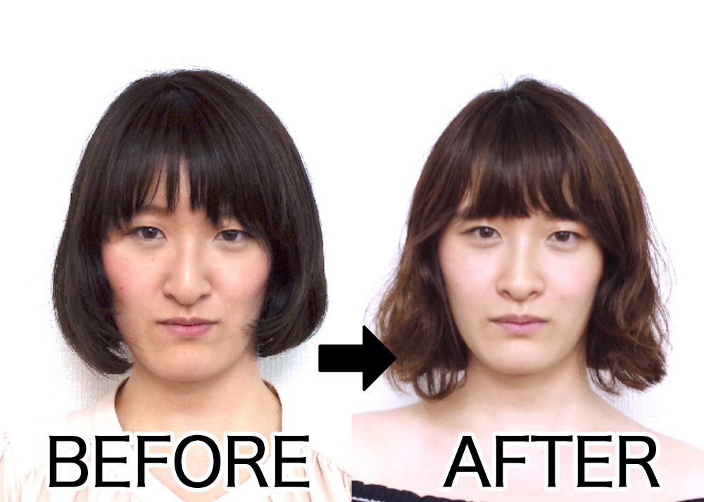 顔を変えなければいけない「顎変形症」の壮絶な手術と術後のガチ体験記【美容整形ではなく歯列矯正】 Pouch[ポーチ]